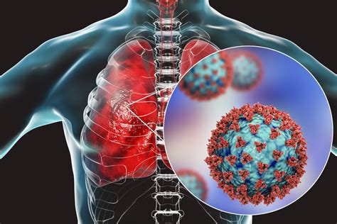 Causes, types and treatment of chest infection - ThePointNG