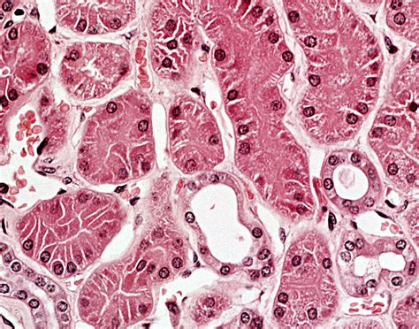 Kidney biopsy