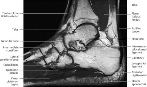 Foot Muscles Mri - Normal Foot Mri Radiology Case Radiopaedia Org ...