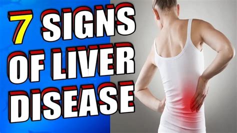 What Are The Early Signs of Liver Disease? | 7 SYMPTOMS You Should Know - Epic Natural Health