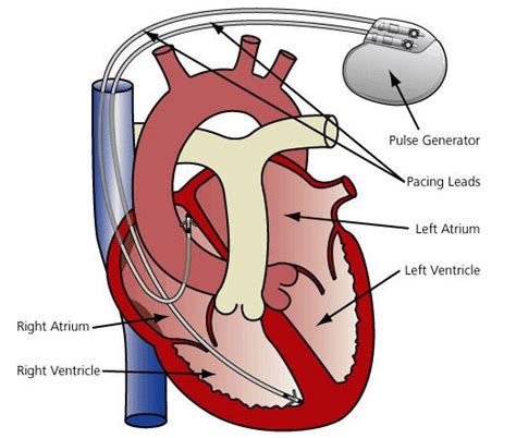 Double Chamber Pacemaker in Kharghar, Mumbai | ID: 10624900948