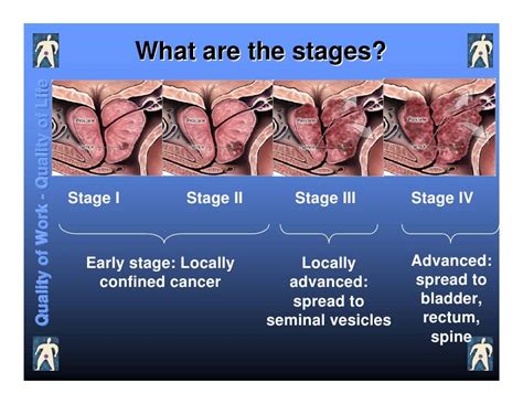 Prostate Cancer Stage 1