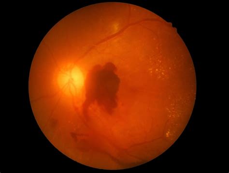 Retinal Bleeding (Retinal Hemorrhages): Types & When to See a Doctor ...