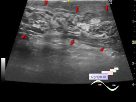 Pediatric Scrotal Ultrasound - Postoperative Funiculitis/ Epididymitis - YouTube