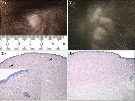 Aplasia cutis congenita of the scalp: Histopathologic features and ...