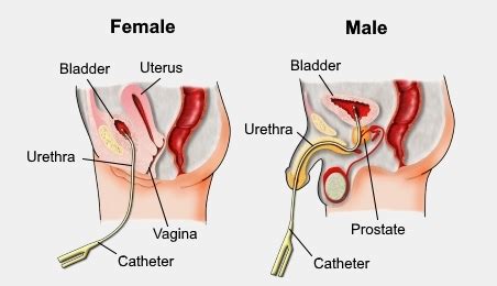 Urinary Catheterization Nursing Procedure & Management - Nurseslabs