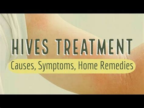 Hives (urticaria) Treatment, Causes, Symptoms, Home Remedies The Natural Cure