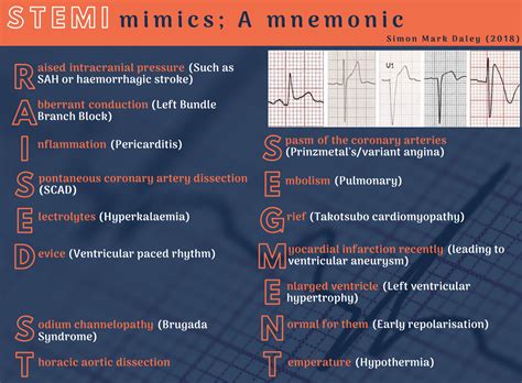 Acute Stemi Management Mnemonic Based Approach Epomedicine | Porn Sex Picture