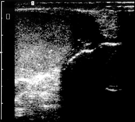 Epididymitis Ultrasound