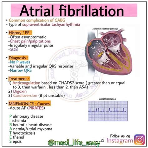 Atrial fibrillation - MEDizzy