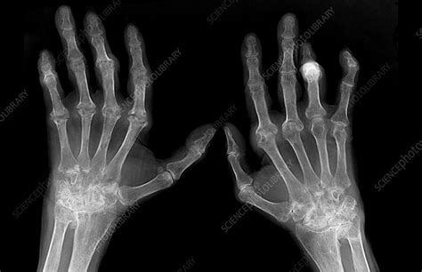 Rheumatoid arthritis, X-ray - Stock Image - C016/9256 - Science Photo Library