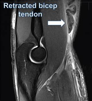 Biceps Tendon Tear at the Elbow - Dr. Groh