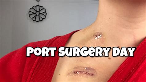 Port Surgery Day!! - YouTube