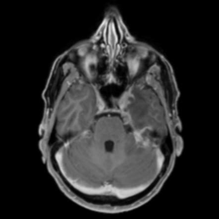 Neurosyphilis Mri