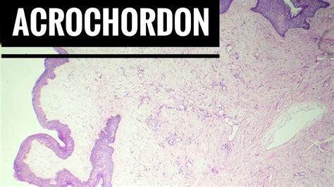 Fibro epithelial Polyp / Acrochordon Histopathology - YouTube