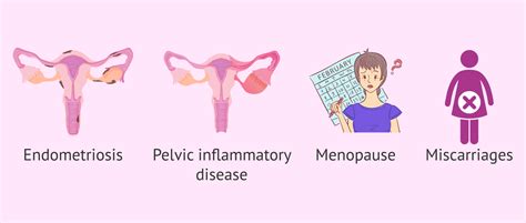 Uterus Tipped Backwards: Causes & Symptomes of Retroverted Uterus