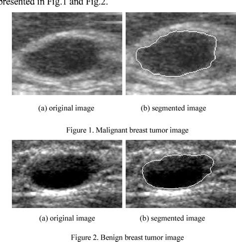 Figure 1 from Textural Feature Analysis for Ultrasound Breast Tumor Images | Semantic Scholar