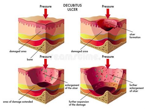 Decubitus ulcer. Medical illustration of the effects of the decubitus ulcer , #ad, #Medical, # ...