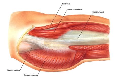 Trochanteric Bursitis | Greater Trochanteric Pain Syndrome | GTPS ...