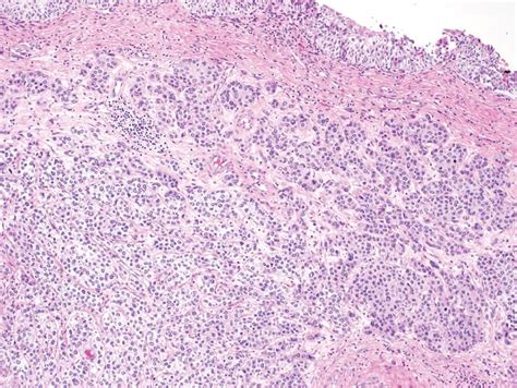 Histologic Variants of Urothelial Carcinoma: Morphology, Molecular Features and Clinical ...