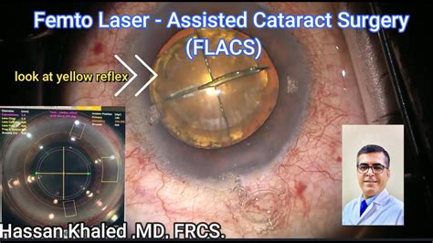 Femto Laser Assisted Cataract Surgery FLACS - YouTube