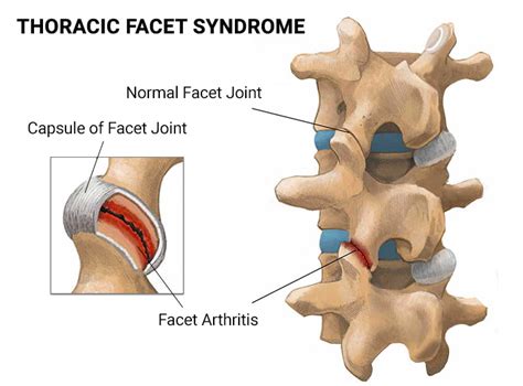 Thoracic Facet Syndrome NJ & NYC