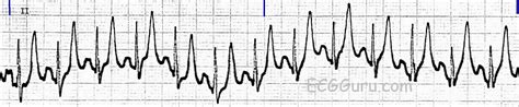 Artifact | ECG Guru - Instructor Resources