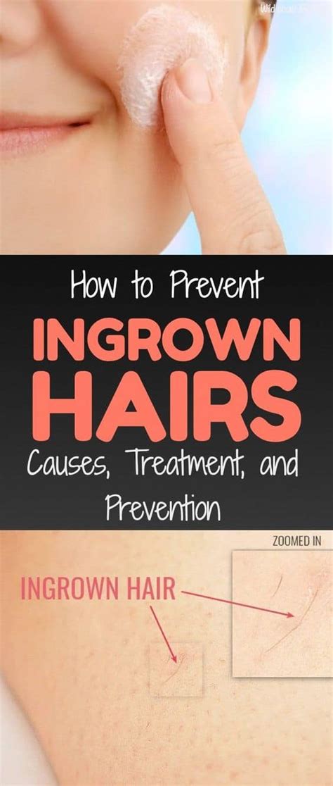 How to Prevent Ingrown Hairs – Causes, Treatment, and Prevention