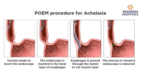 Peroral Endoscopic Myotomy (POEM) for Achalasia