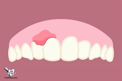 What Is An Abscess Tooth? : Causes, Symptoms, And Treatment