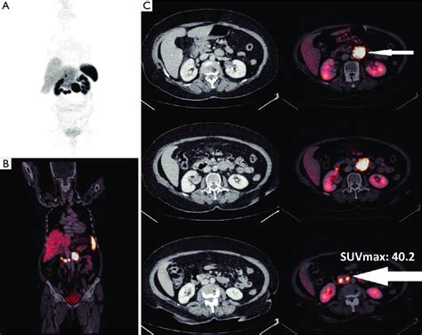 A 67-year-old female presented with metastatic mesenteric lymph node... | Download Scientific ...