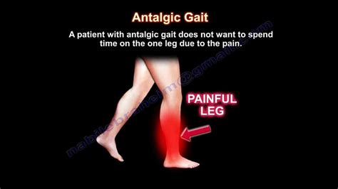 Antalgic Gait - Everything You Need To Know - Dr. Nabil Ebraheim - YouTube