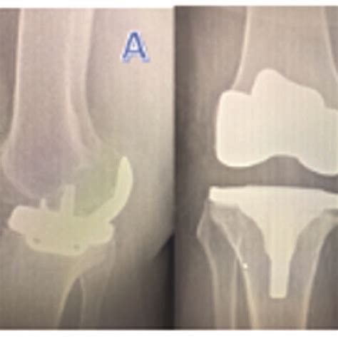 Example of complications. a) Insert dislocation in the suprapatellar ...