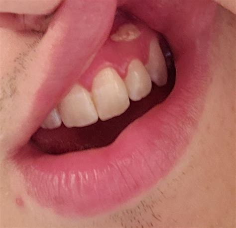 Any thoughts on this white bump on upper gum? Mostly painless, seems to ...