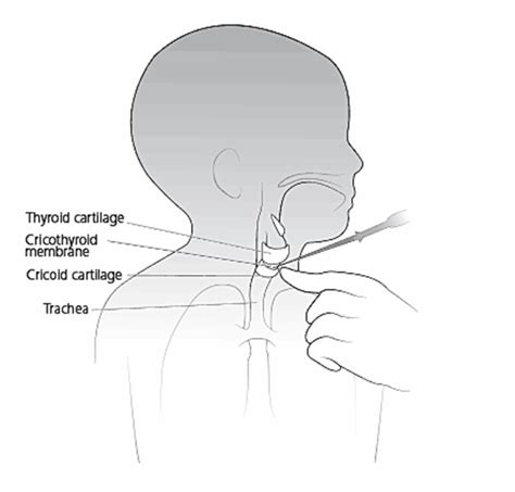 TEMPO Ch7 Paeds Needle Cricothyroidotomy