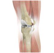 Ligament Injuries | Mr. Vikas Vedi Lower Limb Surgeon Consultant Orthopaedic Surgeon Northwood UK