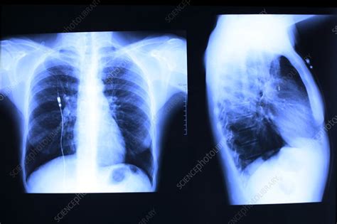 Artificial pancreas - Stock Image - C031/0201 - Science Photo Library