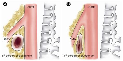 SMA syndrome | Med | Pinterest | Superior mesenteric artery syndrome, Superior mesenteric artery ...