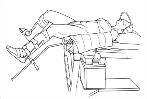 Patient's position – Modified lithotomy position with | Open-i