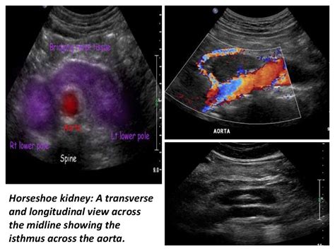 Presentation1.pptx, ultrasound examination of the adrenal glands and