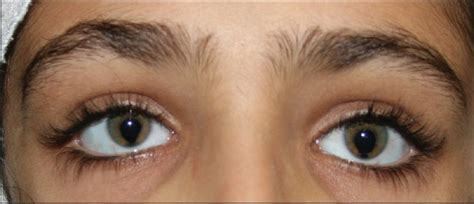 Eye Specialist for Eye Coloboma | Eye Doctor for Coloboma Treatment