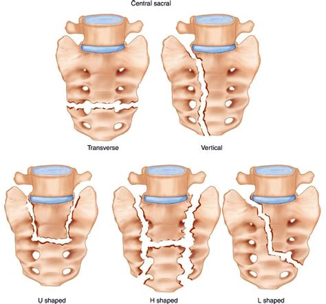 Sacral Fracture - EP Wellness & Functional Medicine Clinic