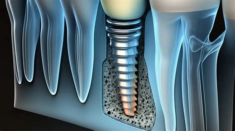 Osseointegration in Dental Implant: Definition, Benefits & Processes