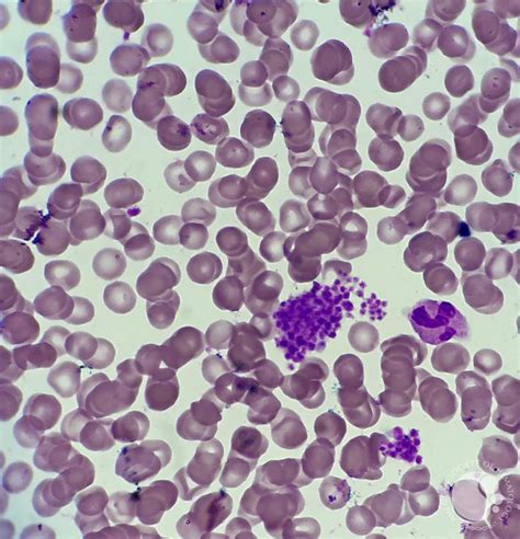 Clumps of platelets in peripheral blood smear