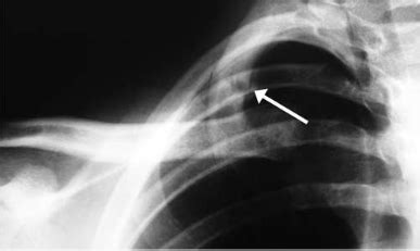 Rib Stress Fracture - Knee & Sports - Orthobullets