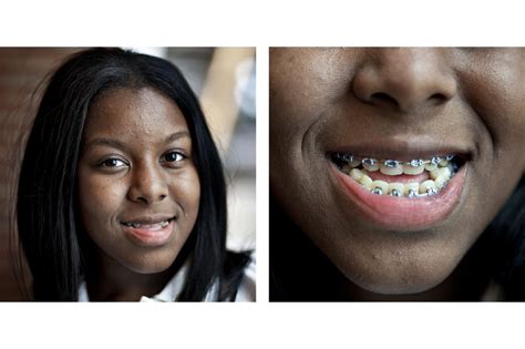 Young braces tiny – Telegraph