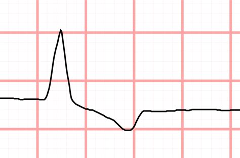 J point ECG