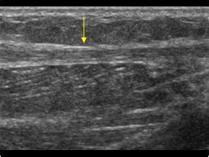 Musculoskeletal, bone, muscle, nerves and other soft tissues | 7.2 Muscle : Case 7.2.6 Plantaris ...