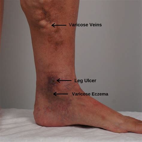 What is the Best Way to Heal a Leg Ulcer? | The VeinCare Centre