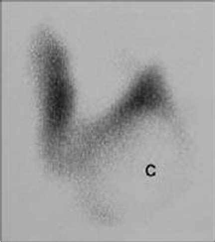 Large cold nodule marked c replacing and displacing the lower pole of... | Download Scientific ...